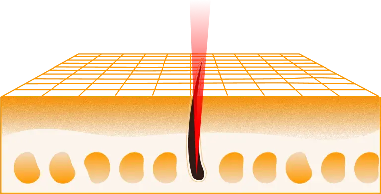 Laser Therapy